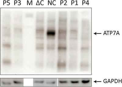 Occipital Horn Syndrome as a Result of Splice Site Mutations in ATP7A. No Activity of ATP7A Splice Variants Missing Exon 10 or Exon 15